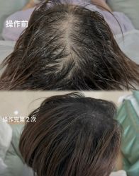 -西施无菌半永久纹绣眉眼影唇轻增发纹发际线
