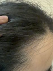 -碧莲盛·不剃发植发