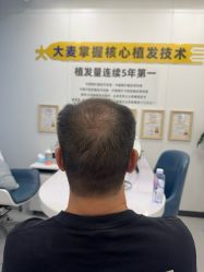-大麦微针植发全国连锁