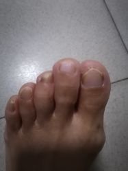 -派恩宜灰指甲鸡眼嵌甲手足癣