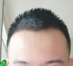 -大麦微针植发丨全国连锁