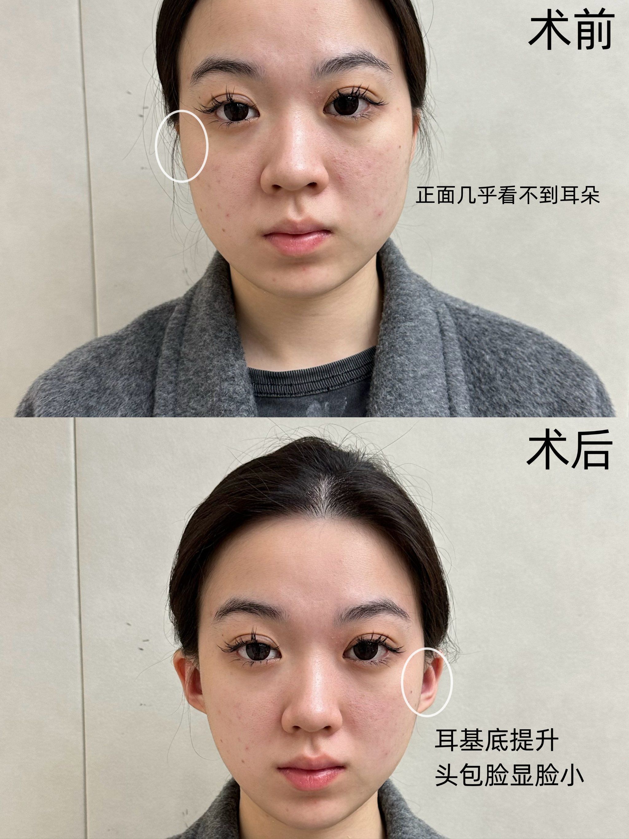 玻尿酸填充耳基底太绝了