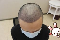 -大麦微针植发丨全国连锁