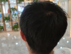 -碧莲盛·不剃发植发