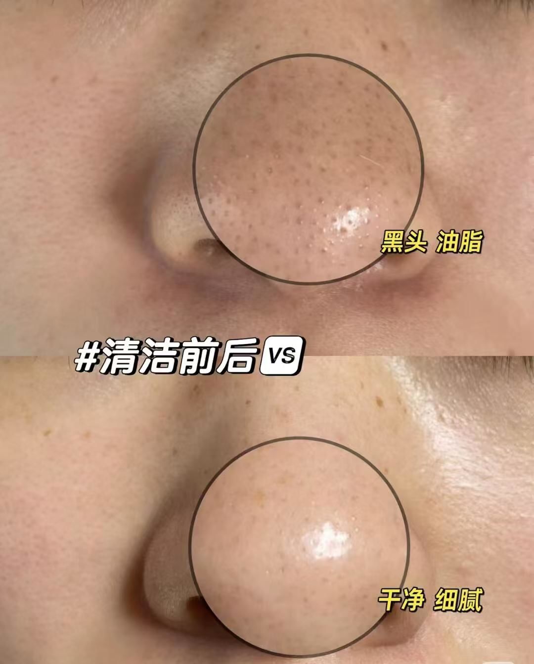 毛孔堵塞 黑头 油脂分泌旺盛 毛孔粗大