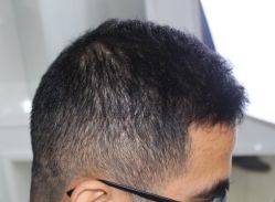 -大麦微针植发全国连锁