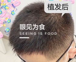 -大麦微针植发全国连锁