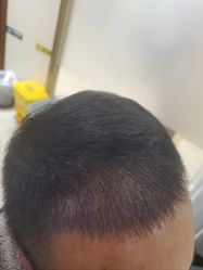 -碧莲盛·不剃发植发