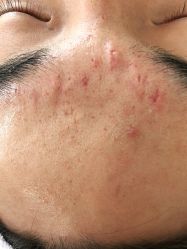 -痘博士北京·全国连锁祛痘机构