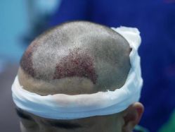 点击看大图 -大麦微针植发丨全国连锁