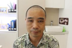 -大麦微针植发丨全国连锁
