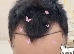 -大麦微针植发全国连锁