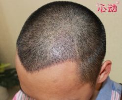 -大麦微针植发丨全国连锁