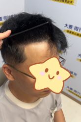 -大麦微针植发丨全国连锁