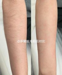 -薇兰专业脱毛连锁机构