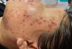 -瑶芳清颜草本祛痘