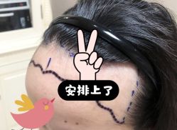 -大麦微针植发全国连锁