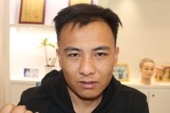 点击看大图 -大麦微针植发丨全国连锁