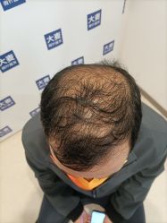 体验前-大麦微针植发丨全国连锁