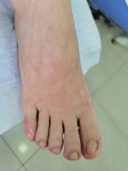 -德哥灰指甲脚气甲沟炎跖疣护理