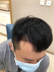 -大麦微针植发丨全国连锁