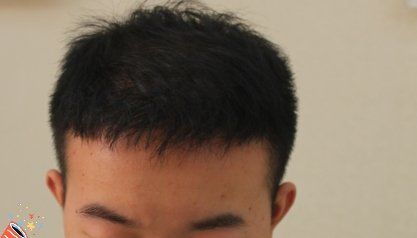 -大麦微针植发丨全国连锁