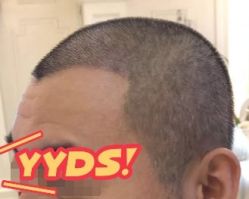 -大麦微针植发丨全国连锁