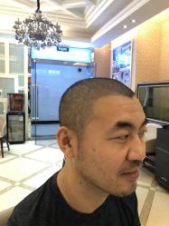 -大麦微针植发丨全国连锁