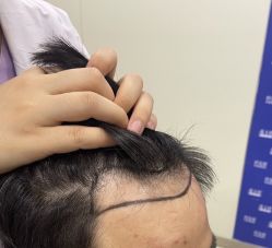 -碧莲盛·不剃发植发
