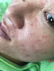 -苗医生草本科技祛痘