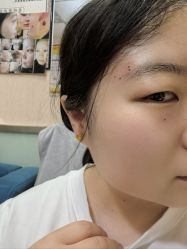 -北京美痣堂古方祛痣斑疣瘊