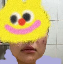 -宜肤清颜专业祛痘问题肌修护