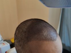 -碧莲盛·不剃发植发