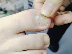 -祖传修脚甲沟炎灰指甲鸡眼