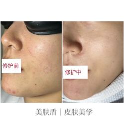 -美肤盾祛痘·问题肌头疗管理中心