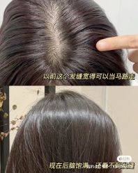 -润复丝·泽发防脱头皮管理