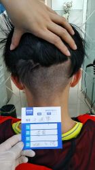 -大麦微针植发丨全国连锁