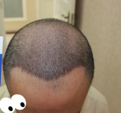 -大麦微针植发丨全国连锁