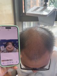 -碧莲盛·不剃发植发