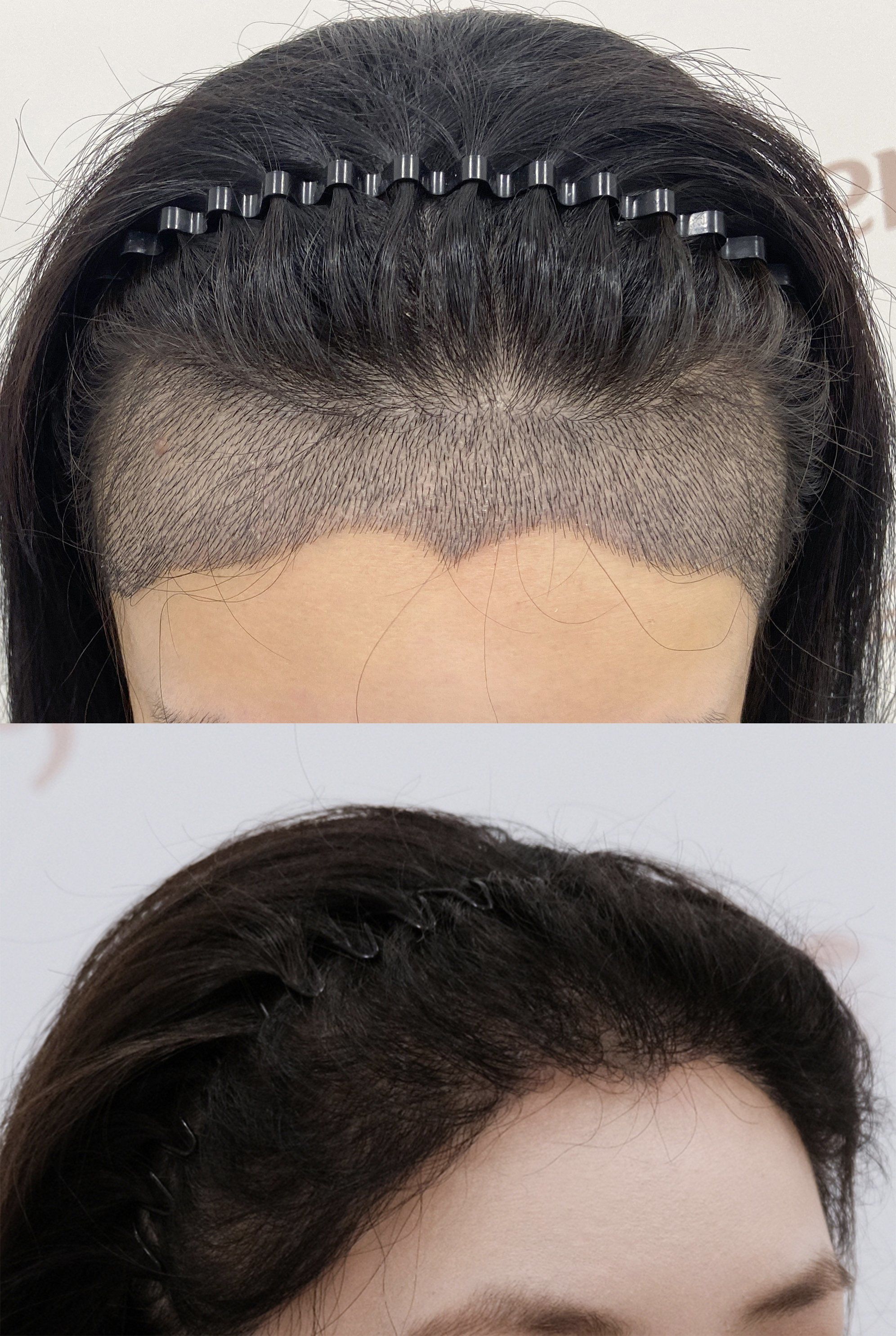 🔥🔥淄博植发哪家好