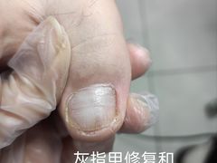 -世龙世家·灰指甲·甲沟炎·嵌甲矫正(双楠店)