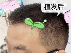-大麦微针植发全国连锁