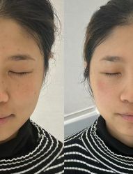 体验前-武汉颜范薇美医疗美容门诊部