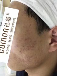-佳慕·痘痘·问题肌管理中心