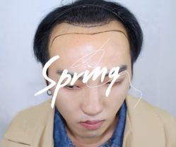 -大麦微针植发全国连锁