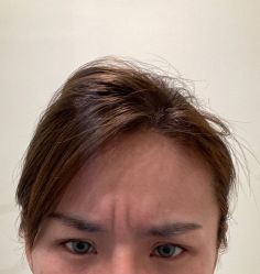 体验前-海涛医疗美容·面部抗衰·注射美鼻