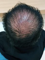 -雍禾植发全国连锁