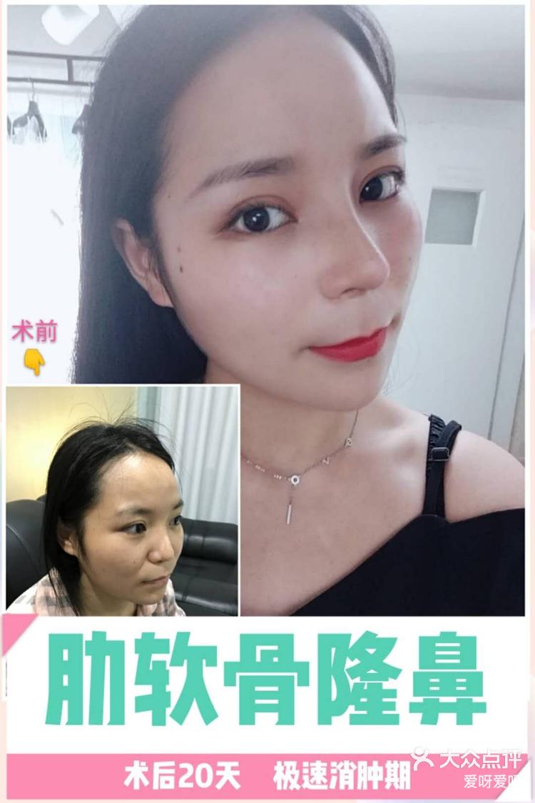 爱呀爱呀 2月26日 18:21 关注 鹰钩蒜头鼻爆改精致直鼻 想做鼻子好多