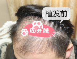 -大麦微针植发全国连锁