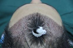 点击看大图 -大麦微针植发丨全国连锁